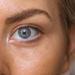 eyelid plasma lift