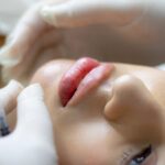 juvederm volbella lip filler