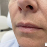 juvederm for lip lines