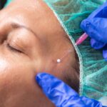 fibroblast plasma skin tightening treatment